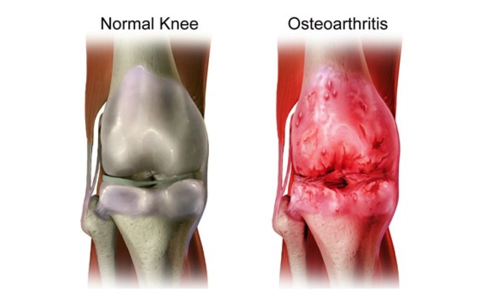One step closer to therapies based on cartilage regeneration