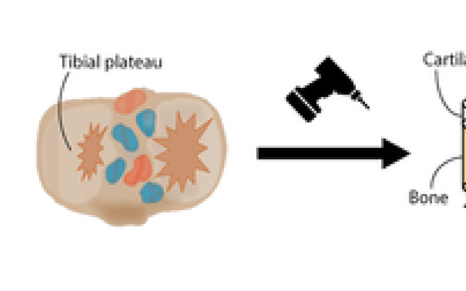 An ex vivo human osteochondral culture model